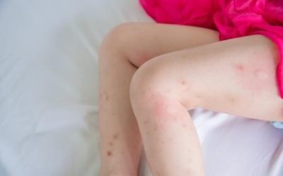 Complete Guide to Bed Bug Bites: Symptoms, Treatment, and Prevention