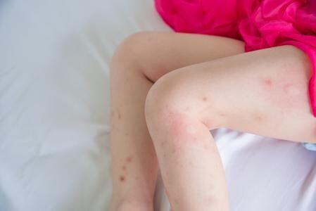 Complete Guide to Bed Bug Bites: Symptoms, Treatment, and Prevention